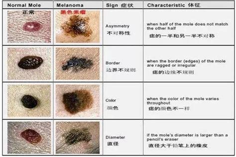 身上有很多痣|哪些痣会癌变？脸上的痣能点吗？专家这回终于说清楚了